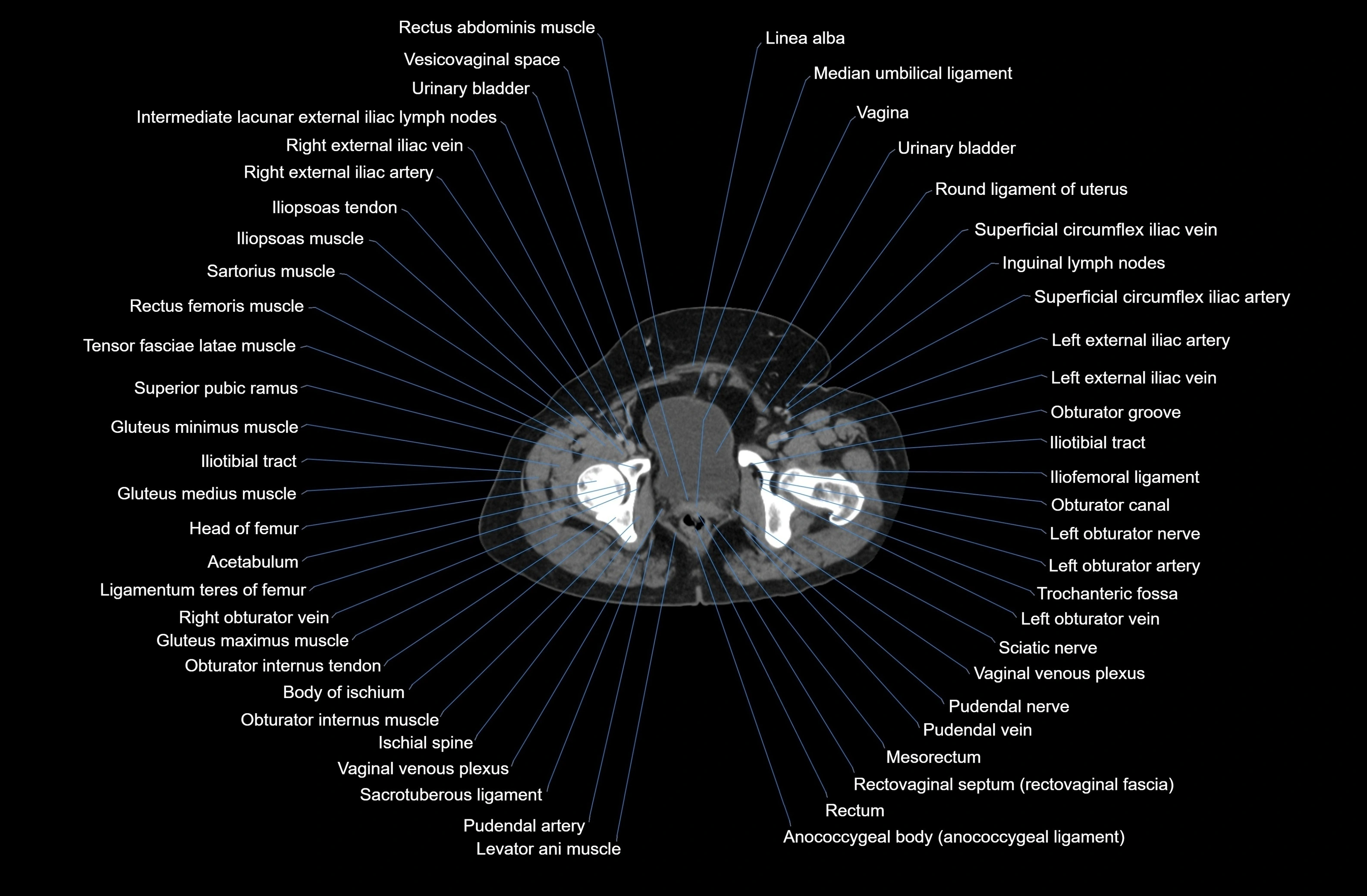 CT Abdomen axial cross sectional anatomy labelled radiology image-00094.webp